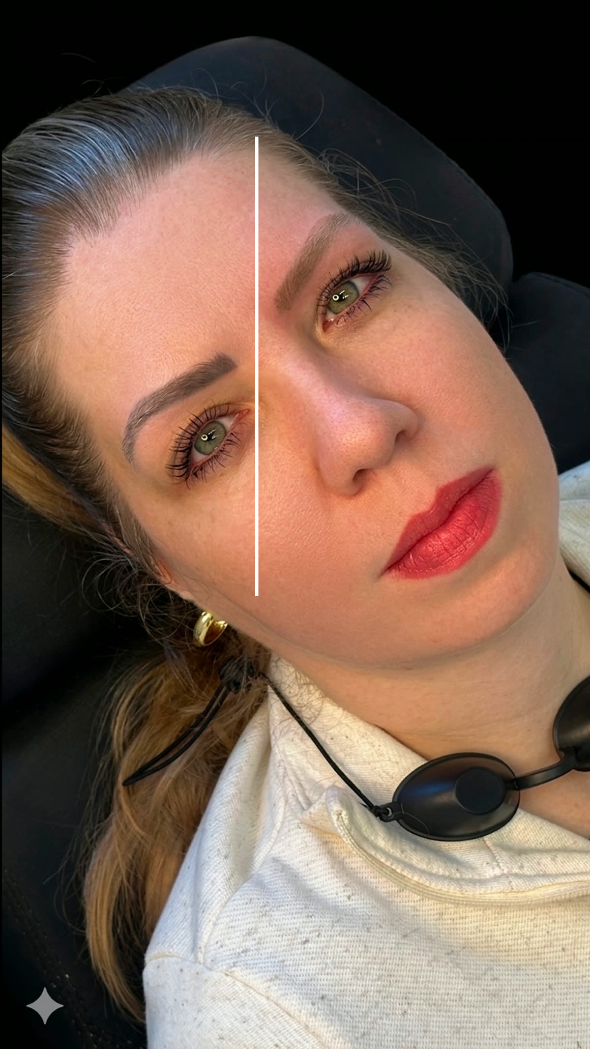 Clareamento de Pigmento — antes e depois